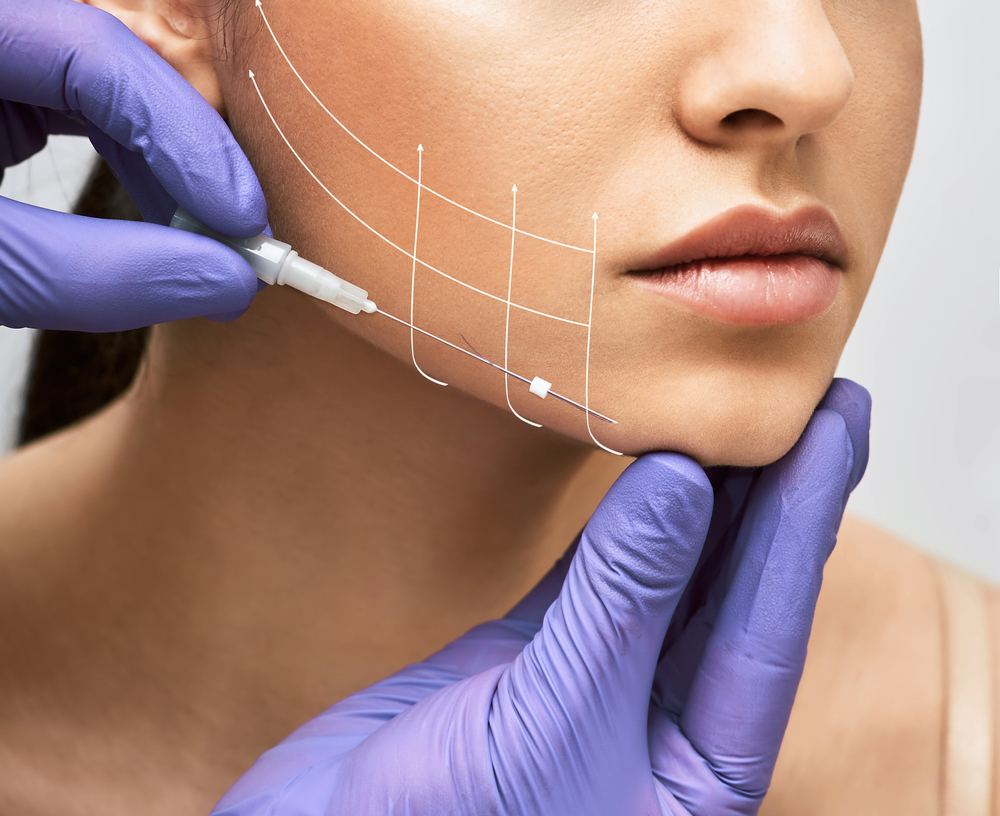 How Long Do Thread Lifts Last for Non-Surgical Facial Rejuvenation