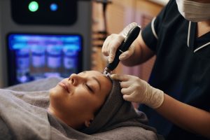 Is Microneedling in Potomac Effective for Acne Scars?