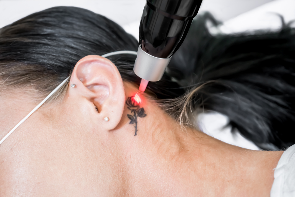 Tattoo Removal Cost Near DC