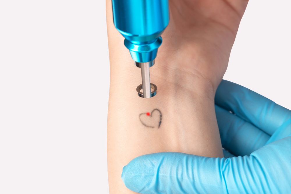 Expert Tattoo Removal Services in Gaithersburg, MD