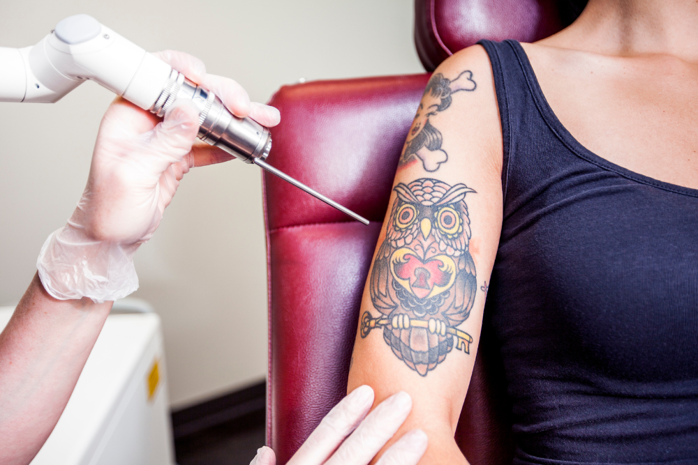 Tattoo Removal in Silver Spring, MD