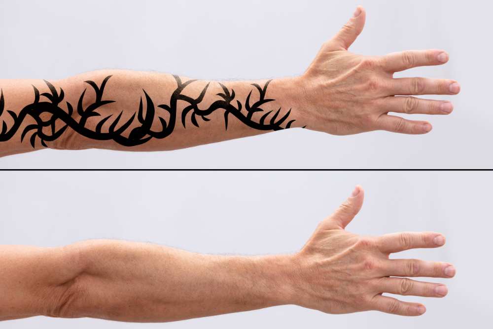 Same-Day Tattoo Removal Treatments in Bethesda