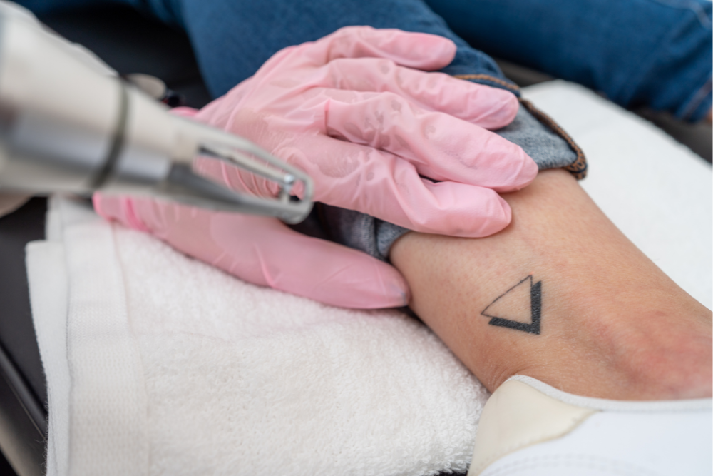 Ultimate Guide to Laser Tattoo Removal in Germantown, Maryland for First-Time Clients