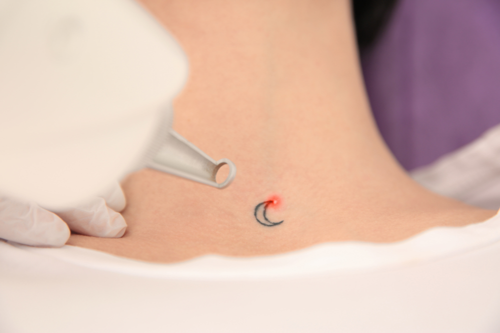 Why Residents of Rockville, Maryland Are Choosing Laser Tattoo Removal to Refresh Their Skin