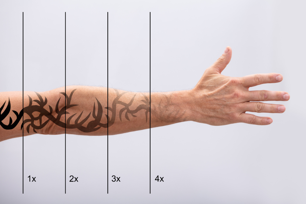 Benefits of Laser Tattoo Removal in Silver Spring, Maryland