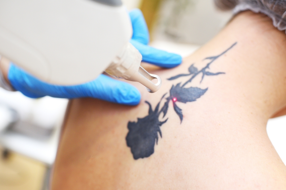 What to Expect When Considering Tattoo Removal Costs in Montgomery County, Maryland