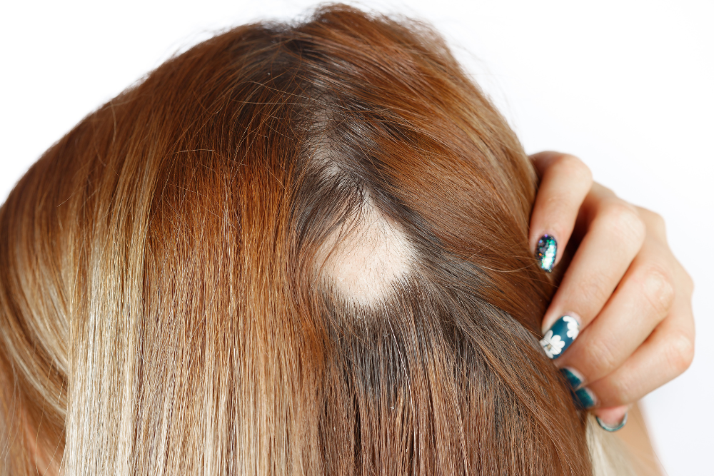 When to Consult an Alopecia Areata Specialist in Potomac, MD