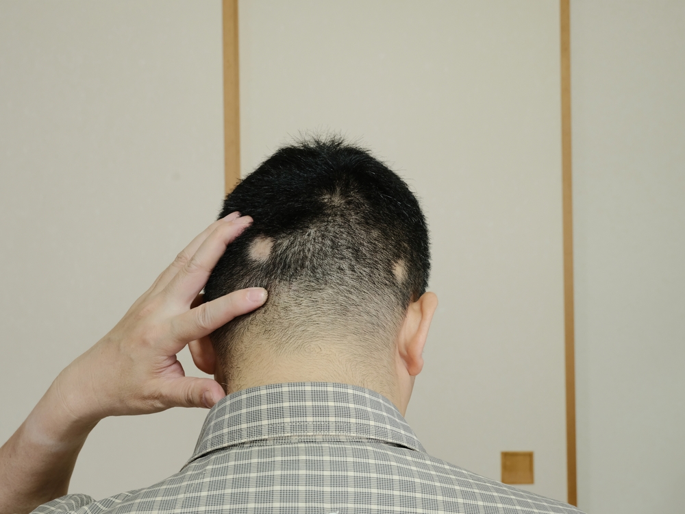 Scarring Alopecia Treatments in Montgomery County, MD