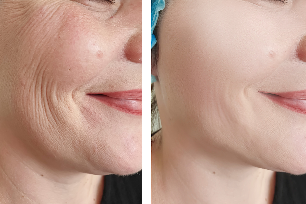 Growth Factors’ Role in Collagen & Elasticity