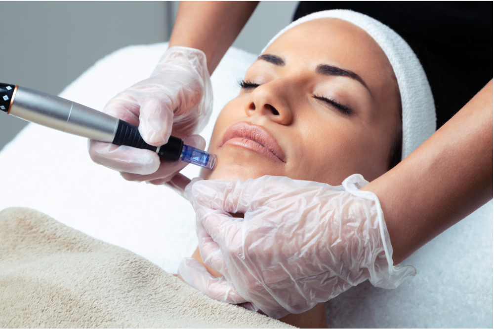Microneedling Treatments for Acne Scars Near Kensington, Maryland