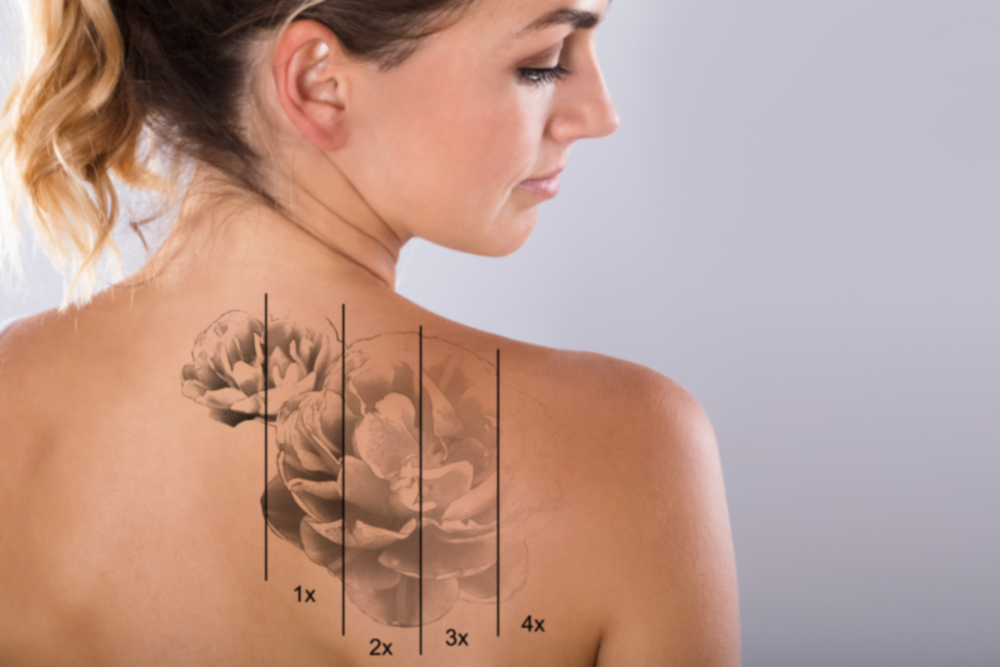 Best Laser Tattoo Removal Treatments in Columbia Maryland