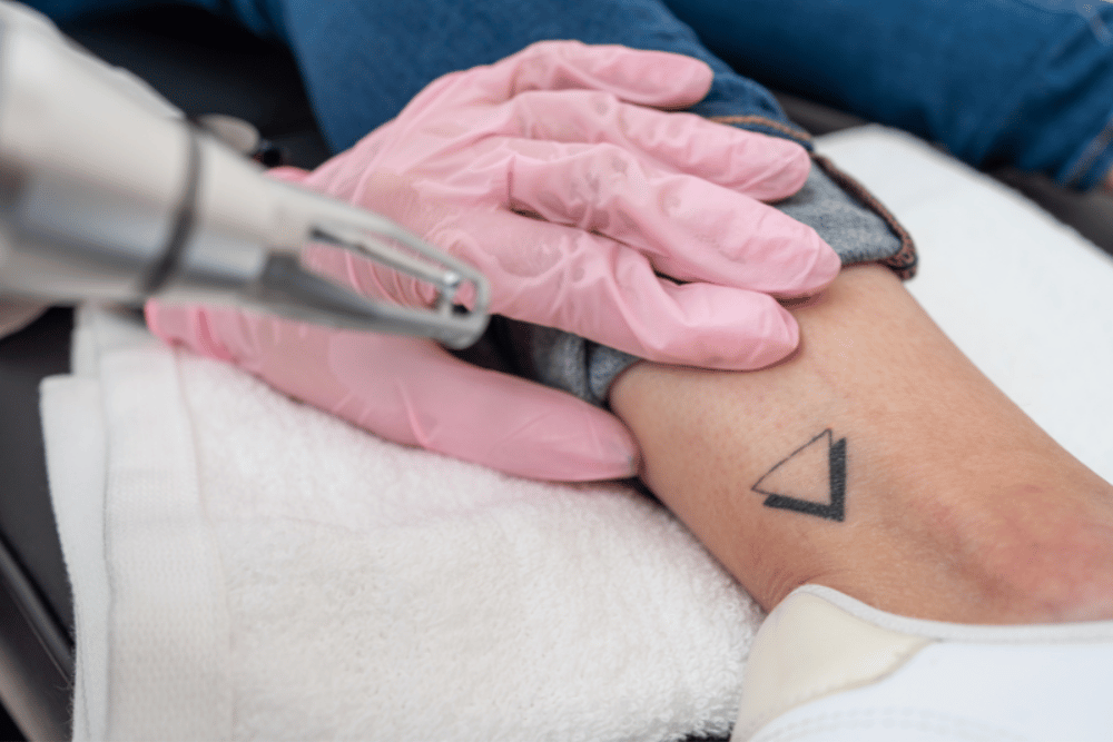 Laser Tattoo Removal Treatments in Annapolis Maryland