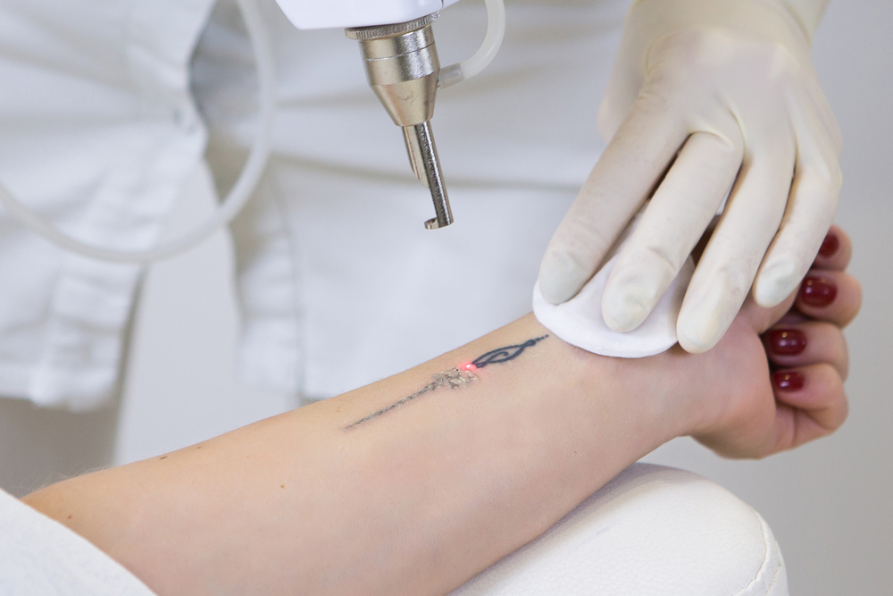 Tattoo Removal Cost in Adams Morgan Washington, DC: How Many Sessions Are Needed