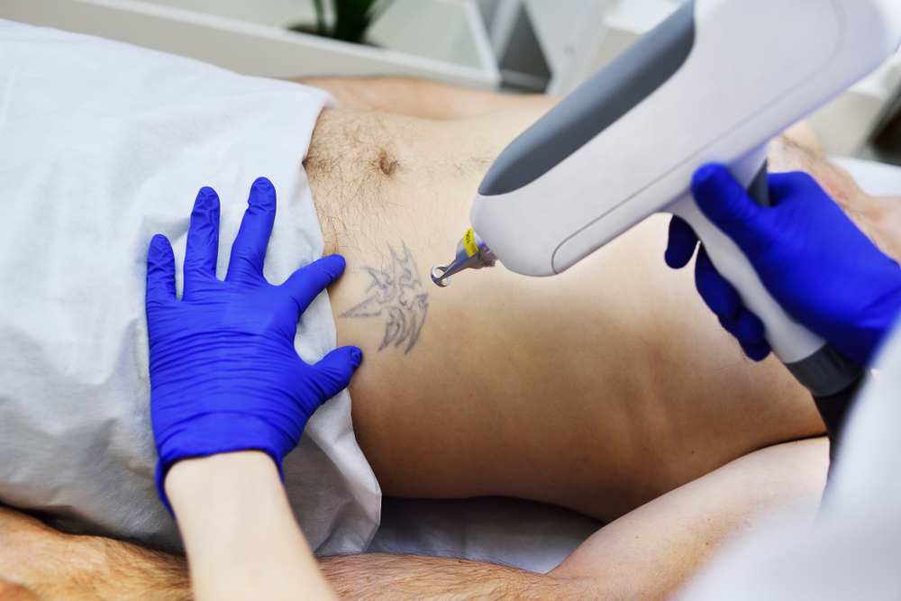 Laser Tattoo Removal Near Rockville Maryland What to Expect
