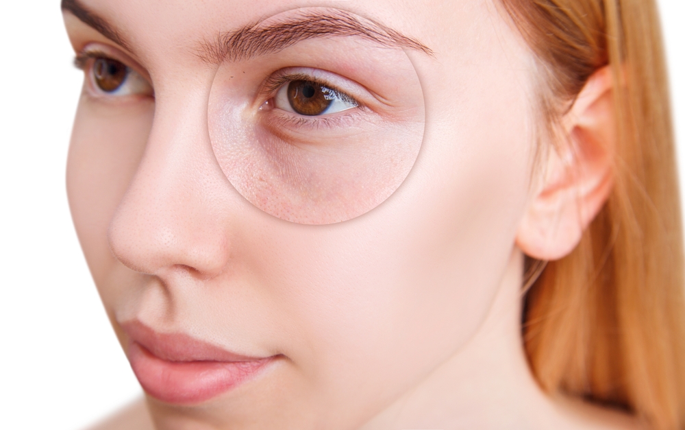 Best Under Eye Filler Injector in Kensington, Maryland for Tear Trough Correction