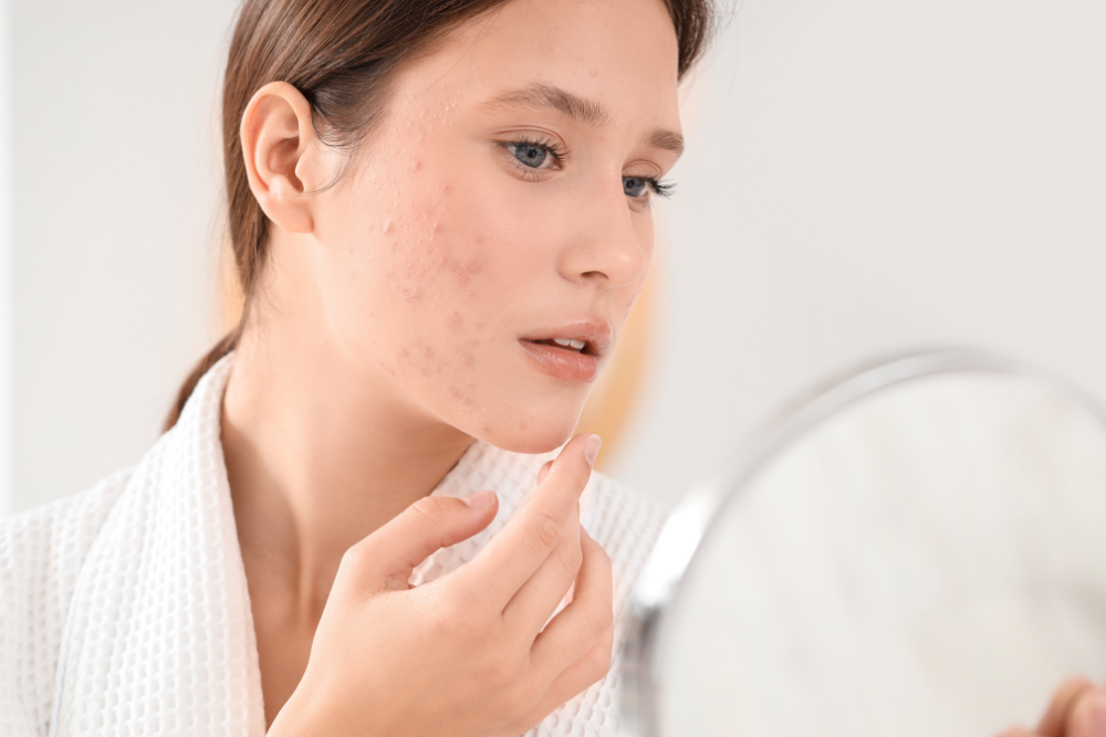 Acne Facial Treatments in Potomac MD