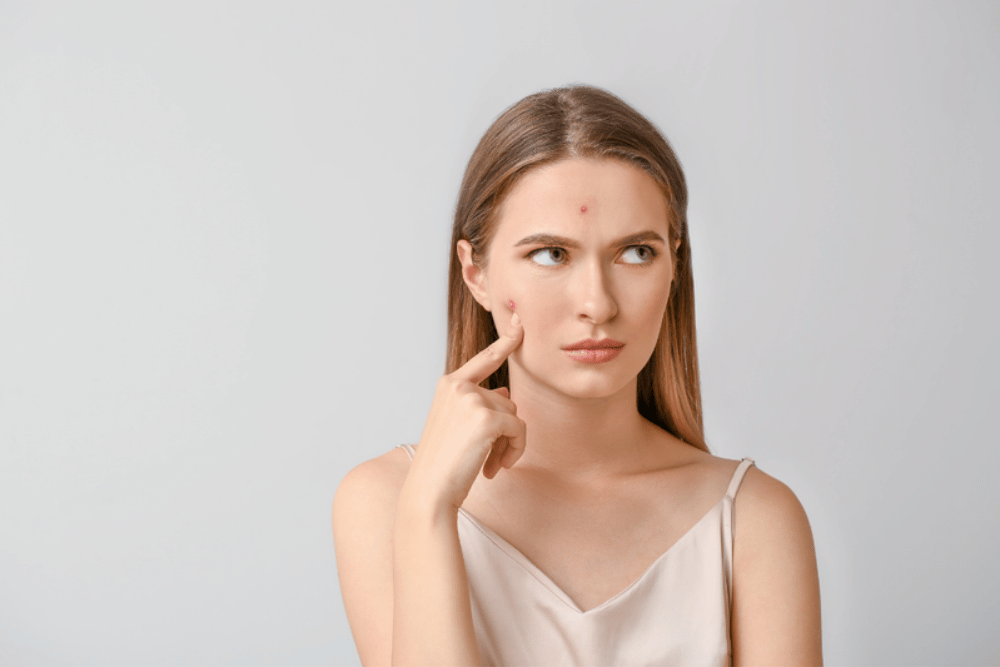 Acne Facial in Chevy Chase MD