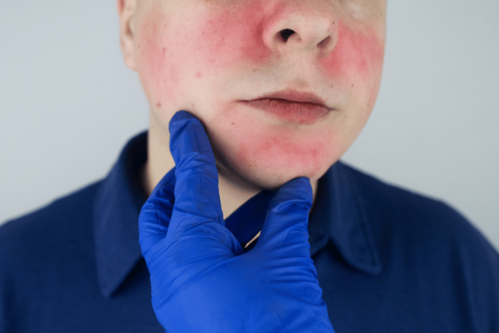 BBL Laser Treatments in Bethesda MD