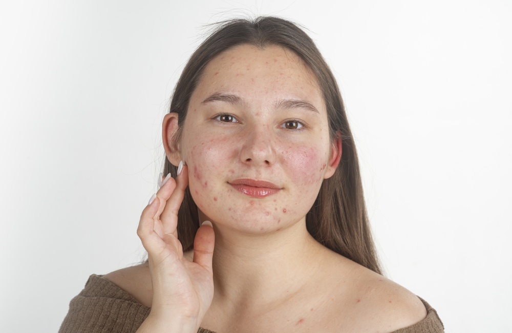 Best Acne Facial Treatments in Silver Spring, MD for Clearer, Healthier Skin