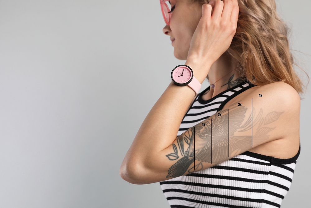Laser Tattoo Removal in Potomac MD